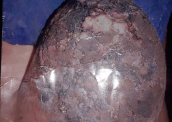 Tamba : Une femme atteinte de Cancer du sein, souffre et sollicite votre soutien pour une intervention.