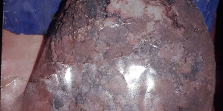 Tamba : Une femme atteinte de Cancer du sein, souffre et sollicite votre soutien pour une intervention.