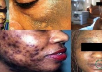 Dépigmentation au Sénégal : Les chiffres effroyables du phénomène